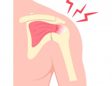 What is a Rotator Cuff Injury?